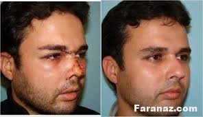 شکستگی بینی و درمان آن شکستگی بینی و درمان آن
