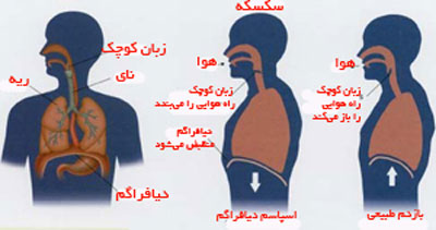دلیل سکسکه چیست و راه درمان آن