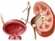 سنگ کلیه و راهکارهایی برای مقابله با آن