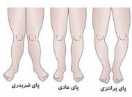 کودکانی که پای پرانتزی دارند!
