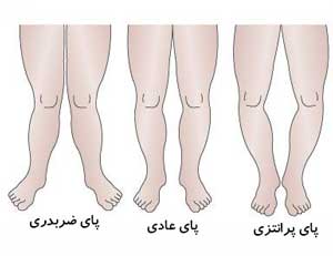 کودکانی که پای پرانتزی دارند!