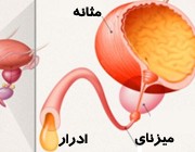 راه های مقابله با مثانه پرکار و تکرر ادرار