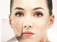 دلیل افزایش جوش ها در تابستان چیست؟