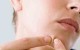 خوراکی هایی که جوش و آکنه را بدتر می کند چیست؟