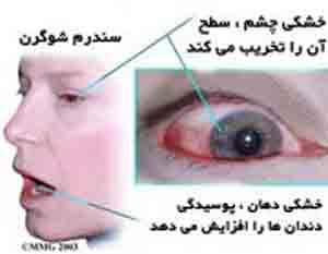 آیا می دانید بیماری «شوگرن» چیست؟ آیا می دانید بیماری «شوگرن» چیست؟