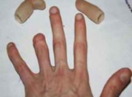 انگشت قطع شده را چگونه براي پيوند به بيمارستان انتقال دهیم