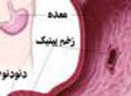 زخم‌ معده چیست و راه های درمان آن