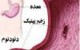 زخم‌ معده چیست و راه های درمان آن
