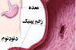 زخم معده چیست و راه های درمان آن زخم معده چیست و راه های درمان آن