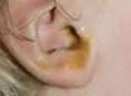 همه چیز درباره پارگی پرده گوش