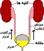 برگشت ادرار از مثانه به طرف کلیه ها(ریفلاکس ادراری) برگشت ادرار از مثانه به طرف کلیه ها(ریفلاکس ادراری)