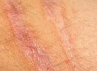 چگونه جای زخم بخیه وجراحی راازروی بدن خودمحو کنیم؟