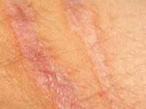 چگونه جای زخم بخیه وجراحی راازروی بدن خودمحو کنیم؟ چگونه جای زخم بخیه وجراحی راازروی بدن خودمحو کنیم؟
