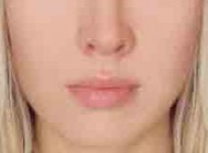 چروک دور لب ها را چگونه درمان کنیم؟