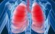درباره بیماری مزمن انسداد ریه (COPD) بیشتر بدانید؟
