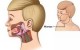 بیماری اوریون و علائم آن