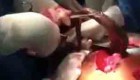 ماهی زنده 60 سانتی از معده یک مرد بیرون آمد(عکس)