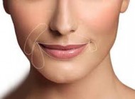 بهترین روش تاثیرگذار برای از بین بردن خطوط خنده