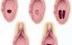 پرده بکارت درچه شرایطی و با چه چیزهایی پاره می شود؟