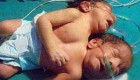 نوزادی دو سر در هند متولد شد!! (+عکس)