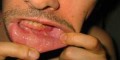 همه چیز درباره آبسه دندان و لثه