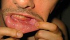 همه چیز درباره آبسه دندان و لثه