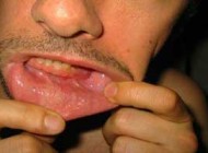 همه چیز درباره آبسه دندان و لثه