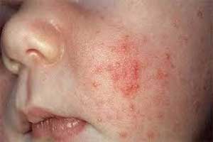 دانستنی های مفید درباره بیماری سرخک دانستنی های مفید درباره بیماری سرخک