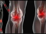 چرا هنگام راه رفتن مفصل زانو صدا می کند؟