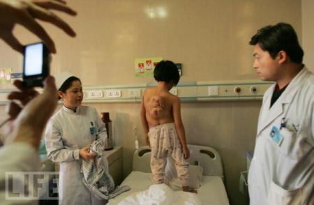 دختر 11 ساله چینی بال دار یکی از عجایب پزشکی! (عکس)