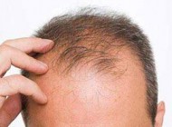 دلیل ریختن موی مرد