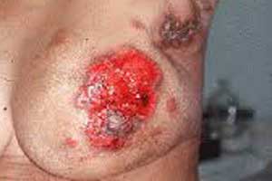 همه چیز درباره ماستیت سینه یا پستان همه چیز درباره ماستیت سینه یا پستان