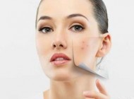 آموزش پوشاندن جوش صورت با آرایش و مکاپ