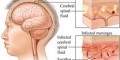 مننژیت چیست؟ علائم، علل بروز و پیشگیری از آن