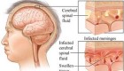 مننژیت چیست؟ علائم، علل بروز و پیشگیری از آن