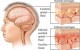 مننژیت چیست؟ علائم، علل بروز و پیشگیری از آن