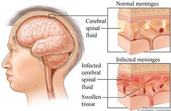 مننژیت چیست؟ علائم، علل بروز و پیشگیری از آن مننژیت چیست؟ علائم، علل بروز و پیشگیری از آن