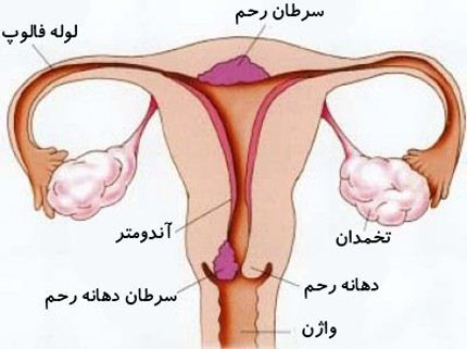همه چیز درباره برداشتن تخمدان در خانم ها