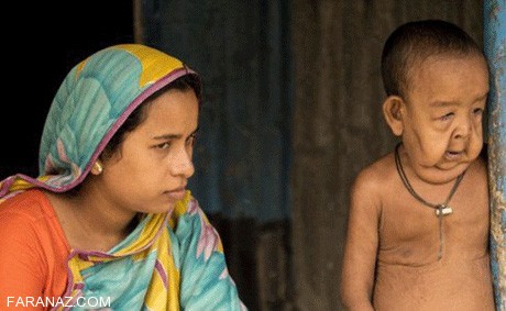 پسر بچه 4 ساله با چهره ای 100 ساله!!! (عکس)