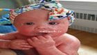 نوزاد دختری که هر 4 ساعت تمام پوستش می ریزد! (+عکس)