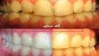 علت زردی دندان چیست؟