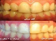 علت زردی دندان چیست؟
