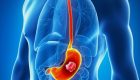 سرطان معده | علائم اولیه و پیشرفته سرطان معده