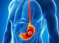 سرطان معده | علائم اولیه و پیشرفته سرطان معده