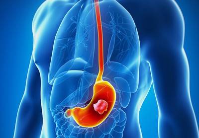 سرطان معده | علائم اولیه و پیشرفته سرطان معده سرطان معده | علائم اولیه و پیشرفته سرطان معده