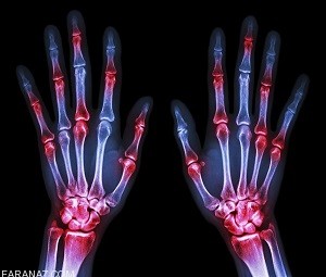 آرتریت روماتوئید چیست؟ علائم و درمان آرتریت روماتوئید