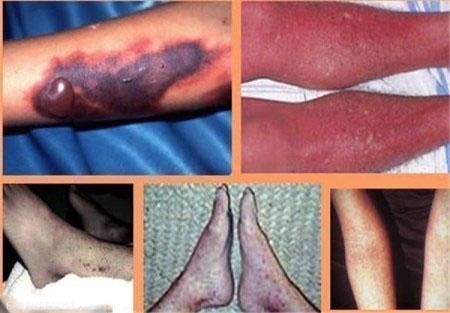 تب کنگو چیست و راه های سرایت تب کنگو به انسان