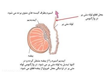 وازکتومی چیست و چه عوارضی دارد وازکتومی چیست و چه عوارضی دارد
