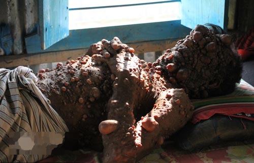 تصاویر مردی که هزاران بیضه روی بدن و صورتش دارد (مرد حبابی)