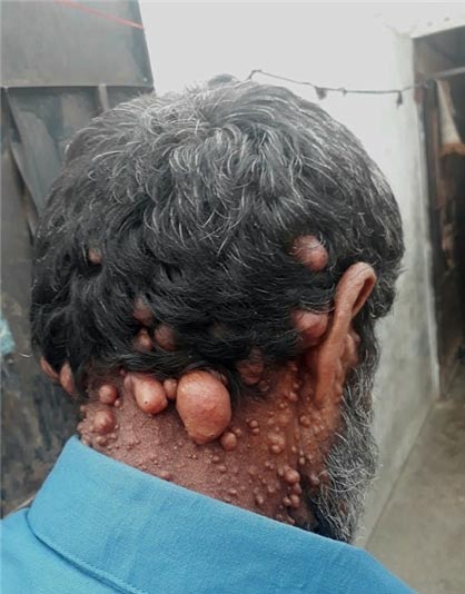 تصاویر مردی که هزاران بیضه روی بدن و صورتش دارد (مرد حبابی) تصاویر مردی که هزاران بیضه روی بدن و صورتش دارد (مرد حبابی)